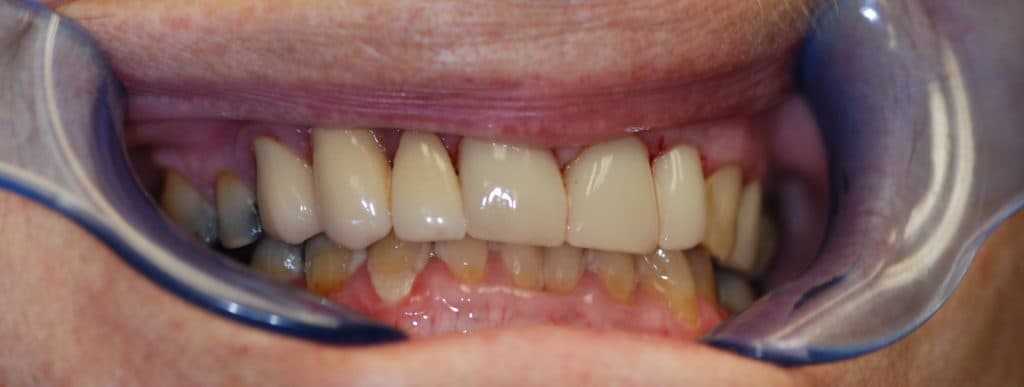 Cosmetic dentistry case 2 - after