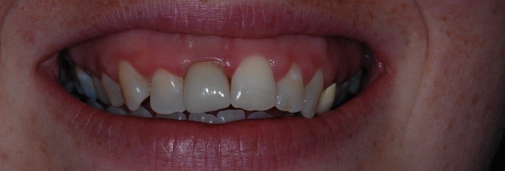 Cosmetic dentistry case 3 - after