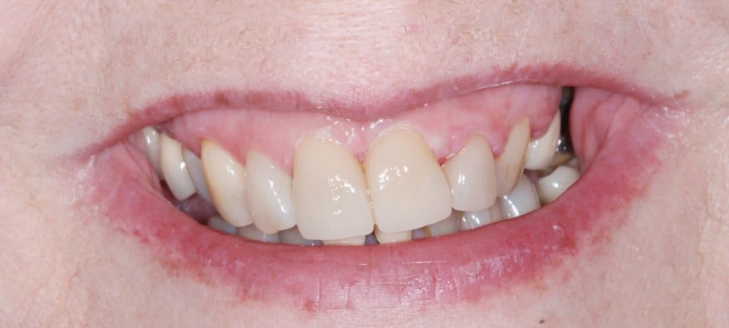 Cosmetic dentistry case 4 - after
