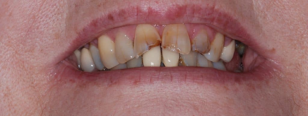 Cosmetic dentistry case 4 - before