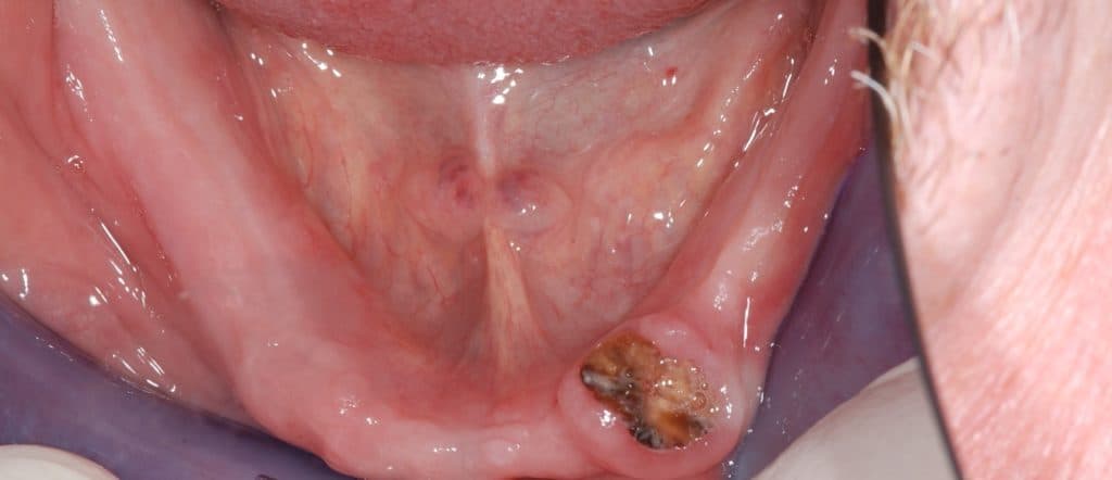 Denture anchored with implants - view 1