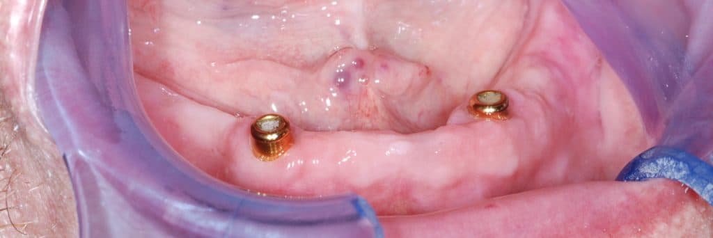 Denture anchored with implants - view 2