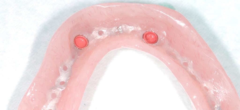 Denture anchored with implants - view 3