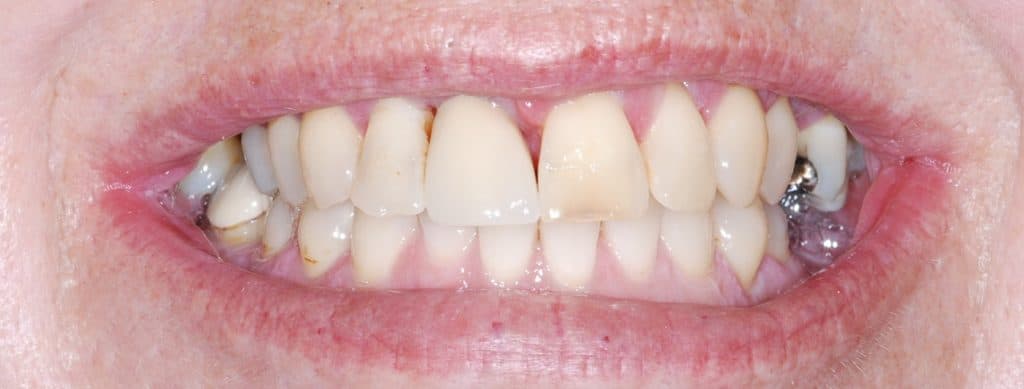 Dental implant case 1 - after