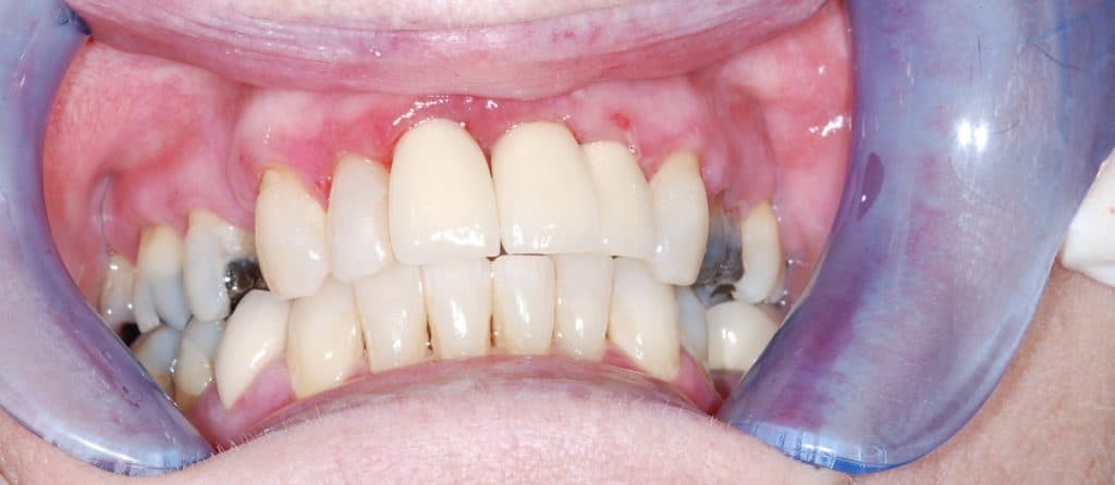 Dental implant case 2 - after