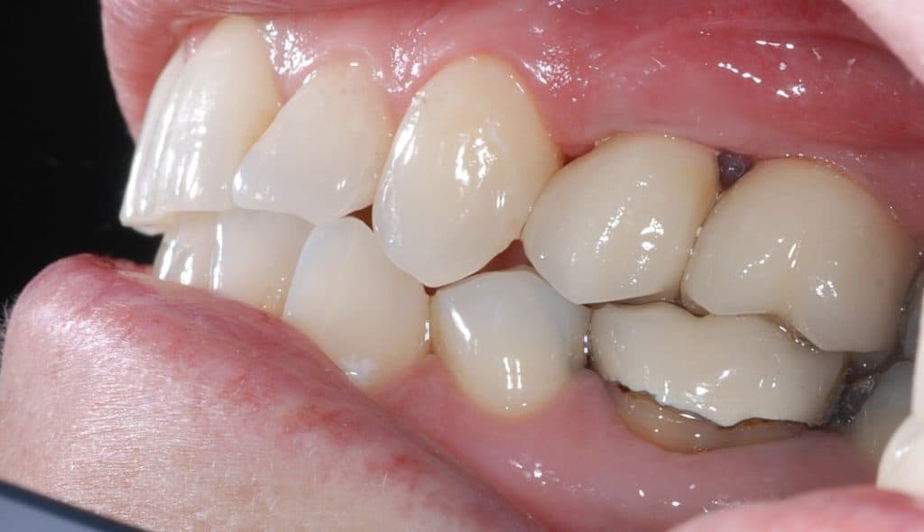 Dental implant case 3 - after