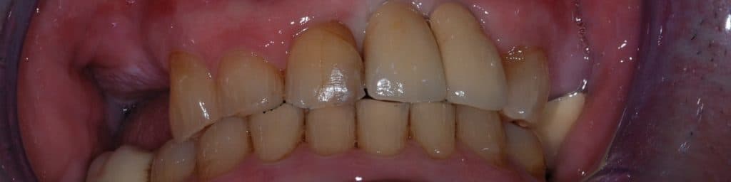 Dental implant case 4 - after