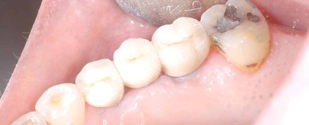 Dental implant case 5 - after