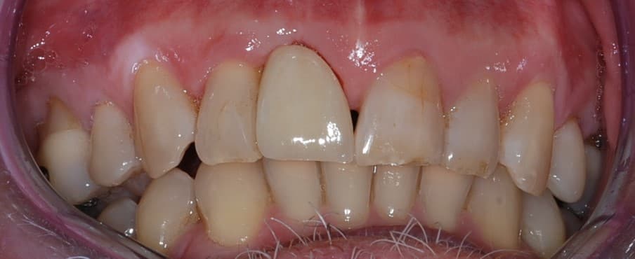 Dental implant case 6 - after