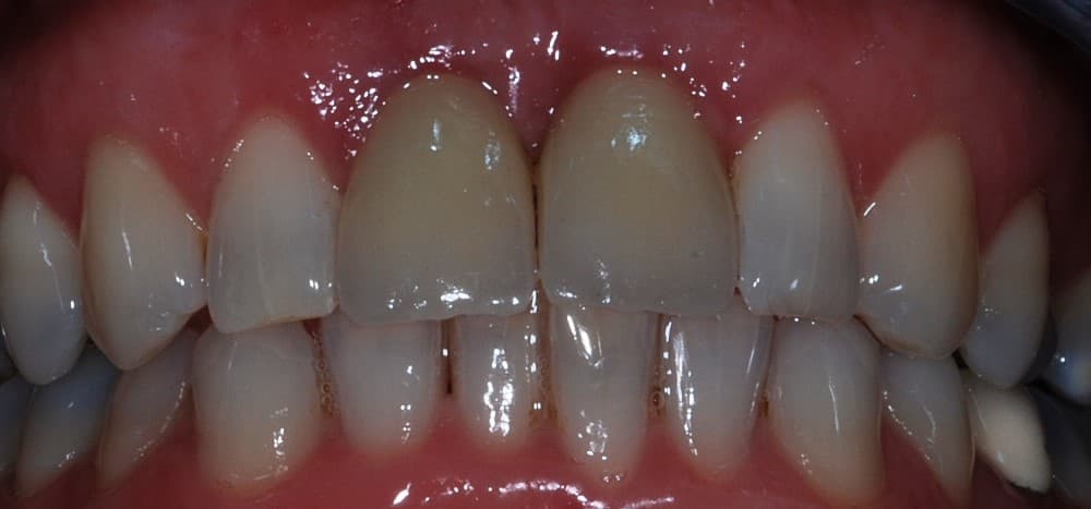 Dental implant case 7 - after