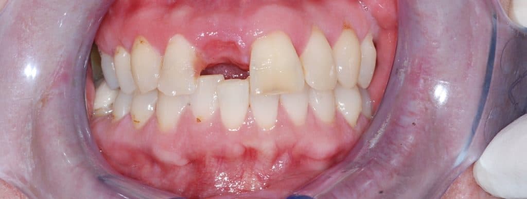 Dental implant case 1 - before