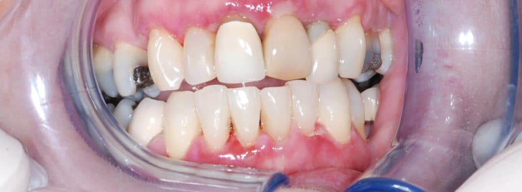 Dental implant case 2 - before