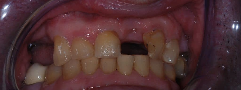 Dental implant case 4 - before