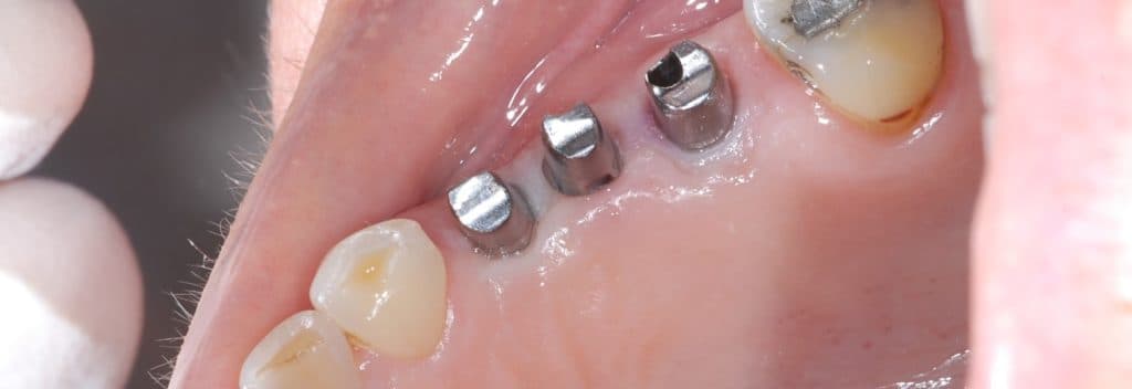 Dental implant case 5 - before