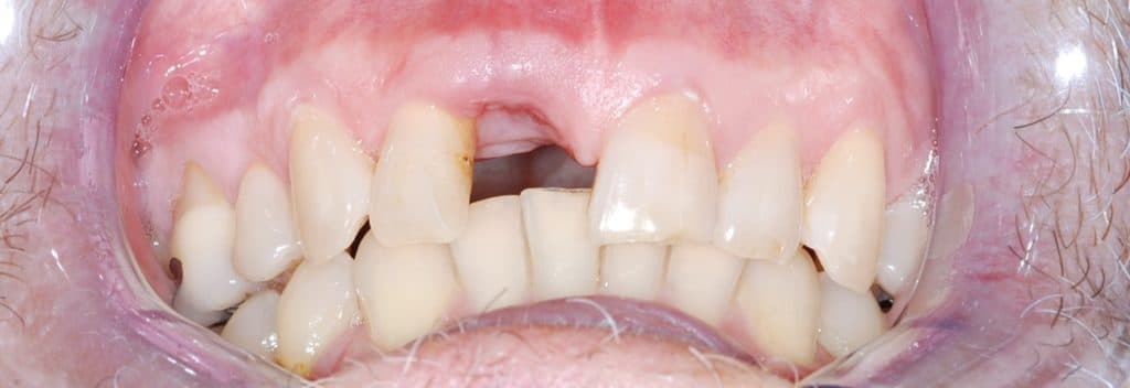 Dental implant case 6 - before