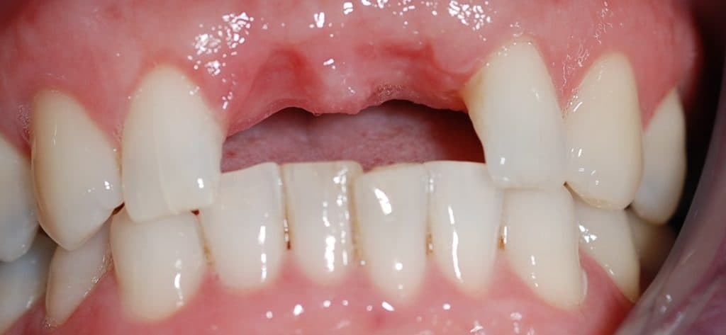 Dental implant case 7 - before