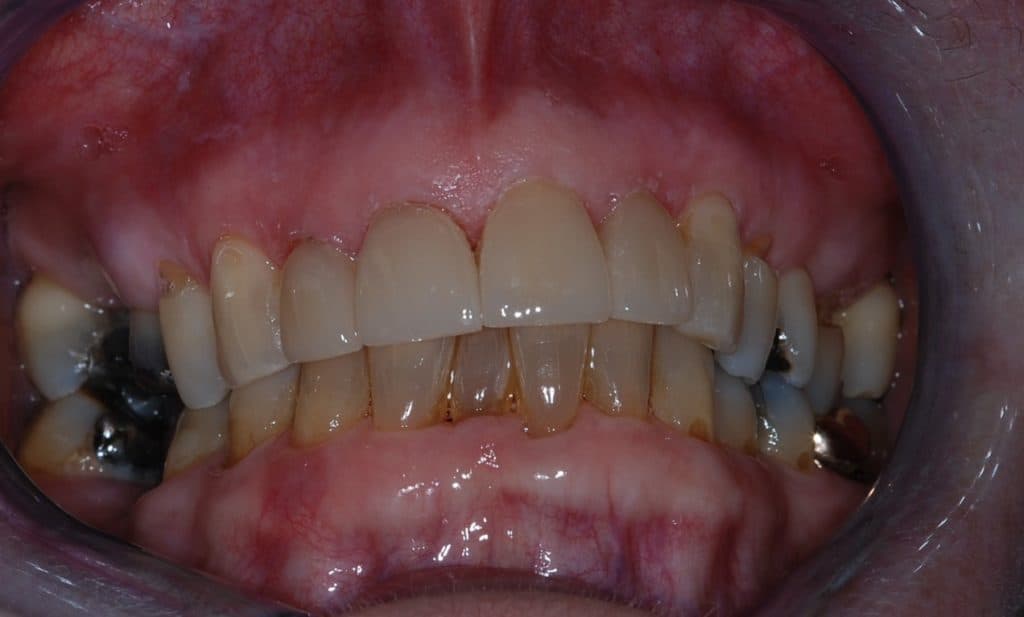 Porcelain veneers results - after