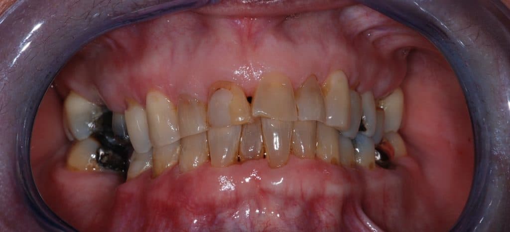 Porcelain veneers results - before