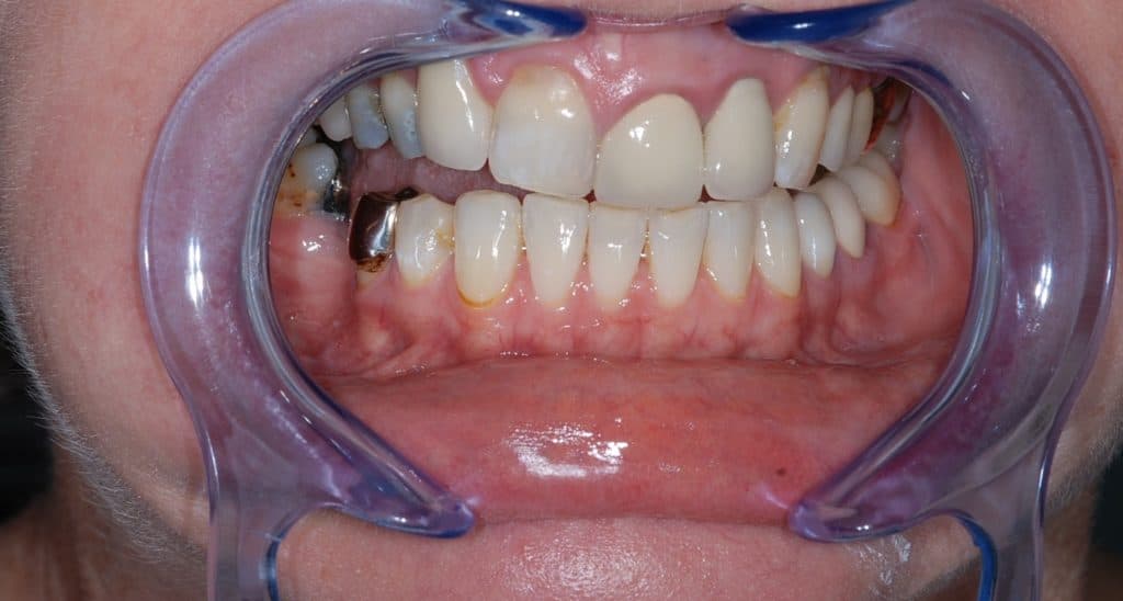 Teeth whitening results - after