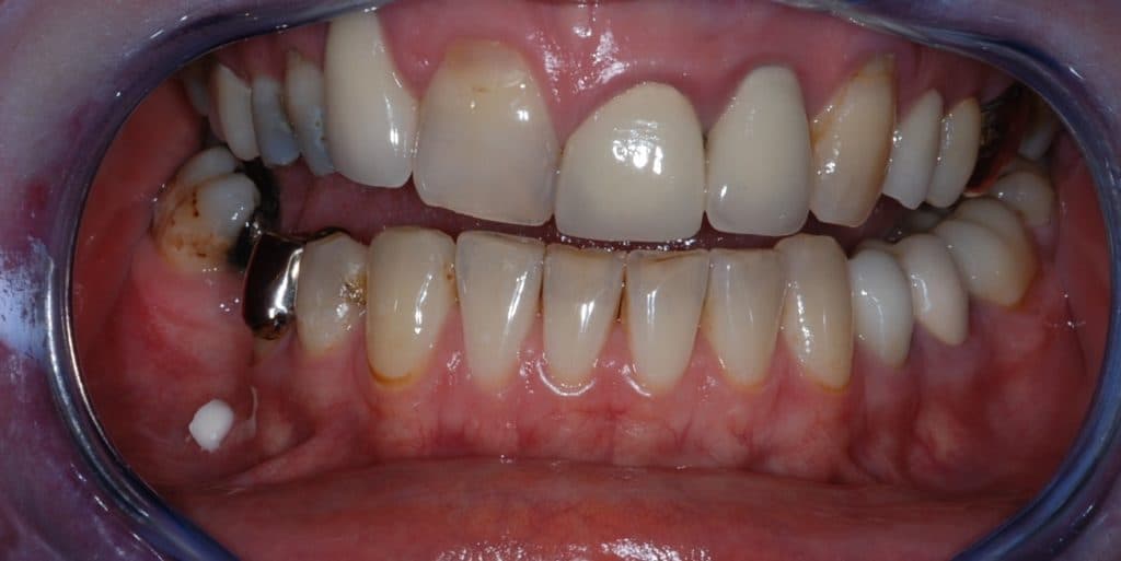 Teeth whitening results - before